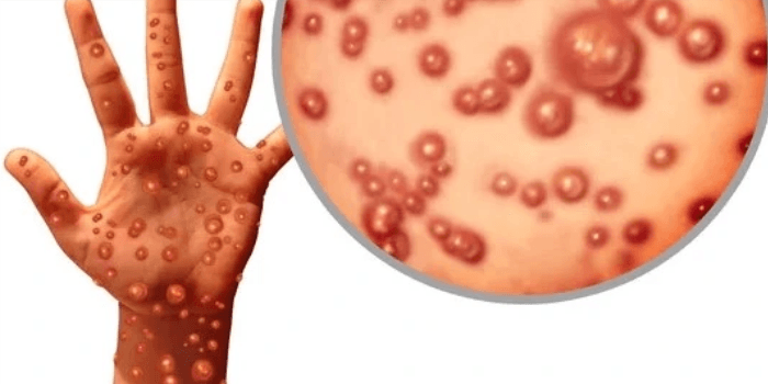 Mengungkap Misteri Monkeypox: Penyakit Zoonosis yang Mengintai Manusia